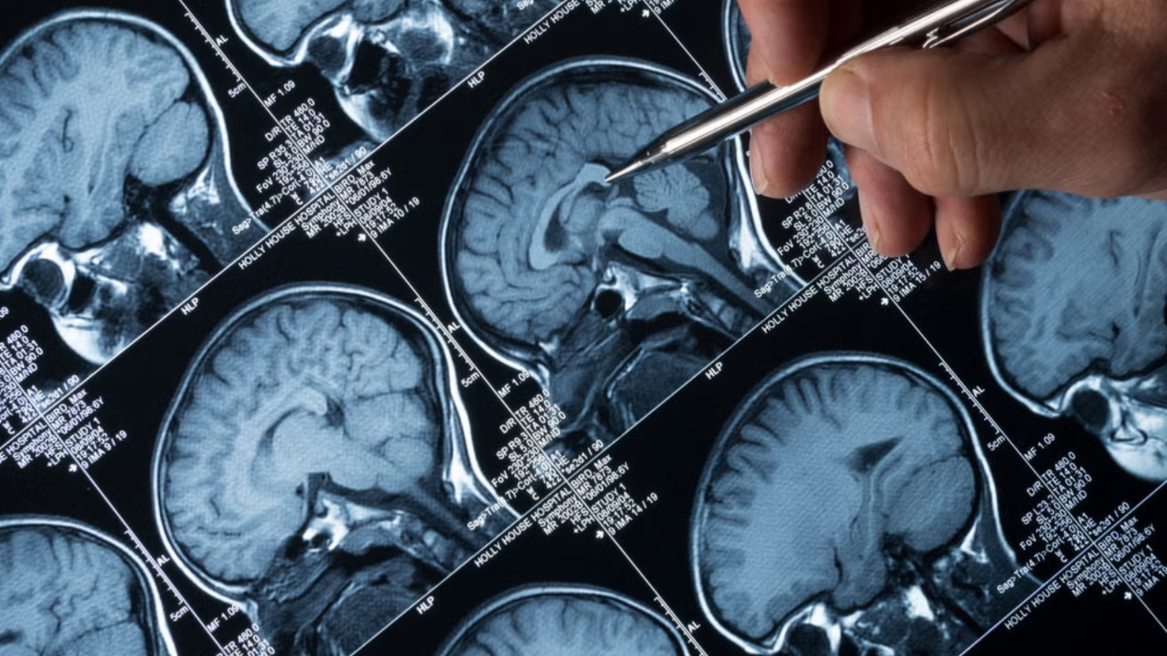 Kan testleriyle Alzheimer’ın birinci belirtileri tespit edilebilir